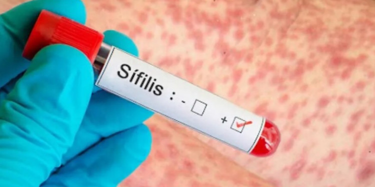 Alerta por el fuerte aumento de casos de sífilis en Argentina