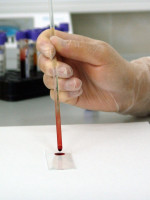 Avanza el test rápido creado por investigadoras argentinas para detectar el cáncer de mama