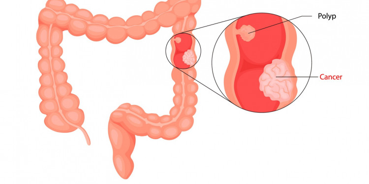 Cáncer de Colon: 9 de cada 10 casos pueden curarse con un diagnóstico temprano