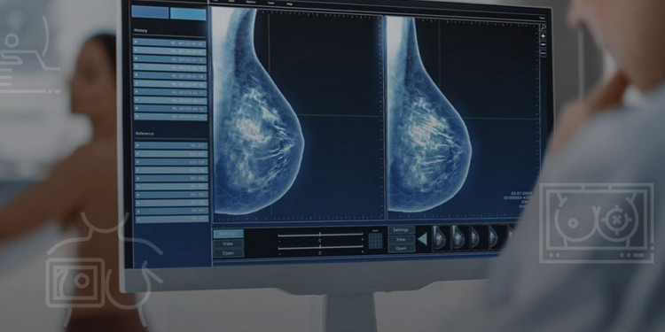 Estudian cómo la IA aporta mayor precisión en el diagnóstico del cáncer de mama