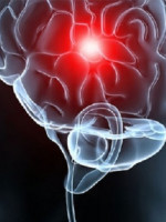 Calidad de vida: factores de riesgo para el accidente cerebrovascular