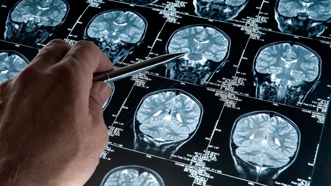 La esperanza contra el alzhéimer, condicionada por los efectos secundarios del nuevo fármaco