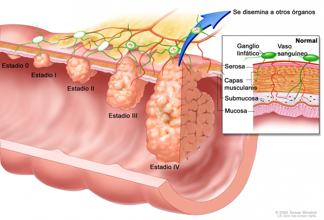 Investigan técnica para pronosticar el cáncer colorrectal hereditario