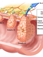 Investigan técnica para pronosticar el cáncer colorrectal hereditario