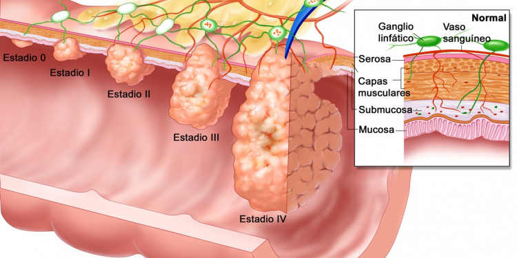 Investigan técnica para pronosticar el cáncer colorrectal hereditario