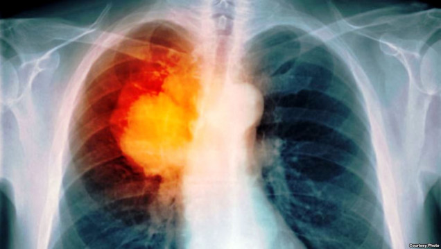 imagen Para la OMS, 1 de cada 5 personas desarrollará cáncer durante su vida