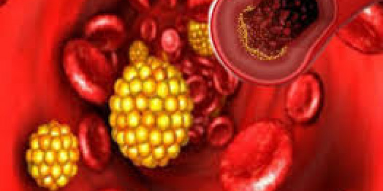Factores de riesgo: triglicéridos y colesterol alto