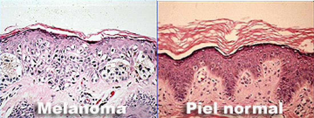 Melanoma: un tipo de cáncer aún sin medicina eficaz.