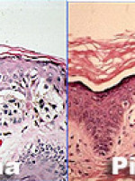 Melanoma: un tipo de cáncer aún sin medicina eficaz.