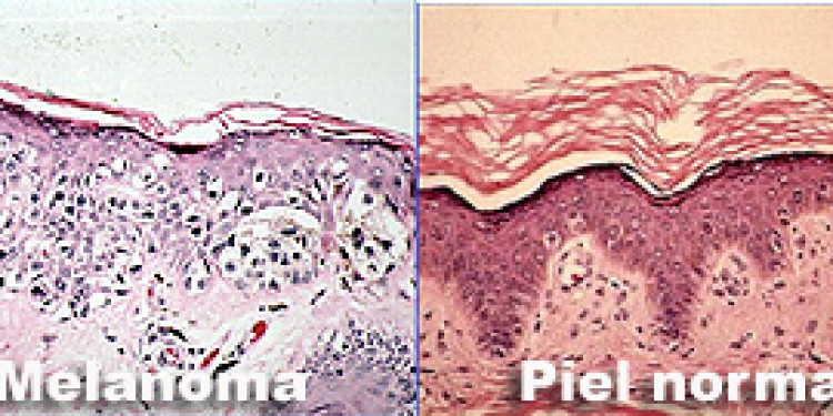 Melanoma: un tipo de cáncer aún sin medicina eficaz.