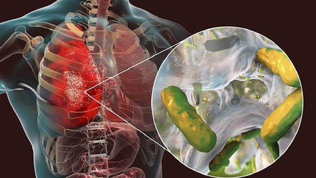 imagen Conicet: encuentran la clave de la resistencia a antibióticos en un paciente con fibrosis quística