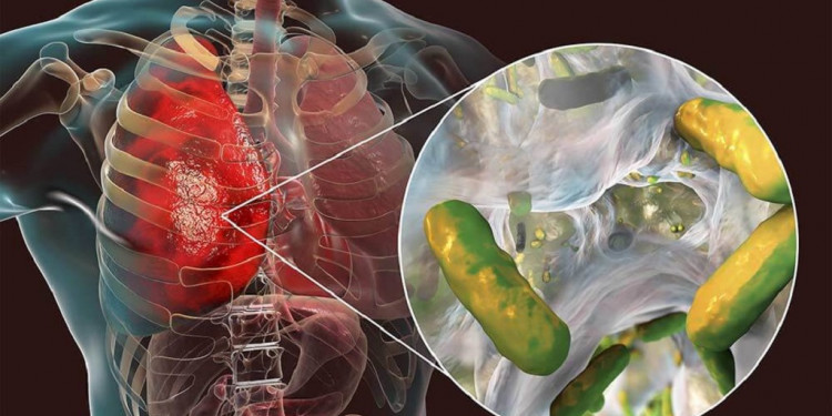 Conicet: encuentran la clave de la resistencia a antibióticos en un paciente con fibrosis quística