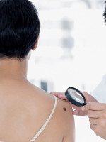Controlar lunares, el eje de una nueva campaña contra el melanoma