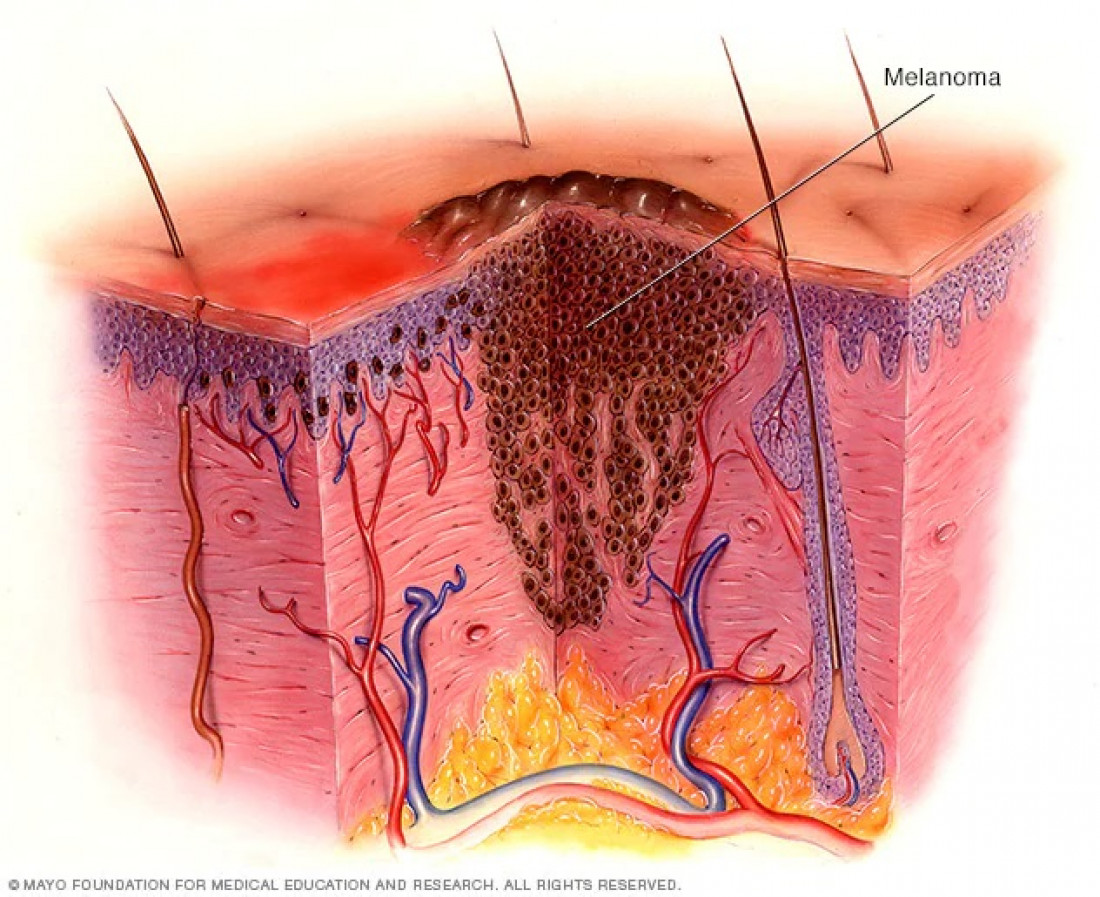 Avance argentino en tratamientos antitumorales: el caso de terapias anti-angiogénicas en pacientes con melanoma