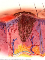 Avance argentino en tratamientos antitumorales: el caso de terapias anti-angiogénicas en pacientes con melanoma