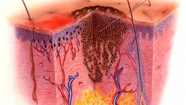 imagen Avance argentino en tratamientos antitumorales: el caso de terapias anti-angiogénicas en pacientes con melanoma