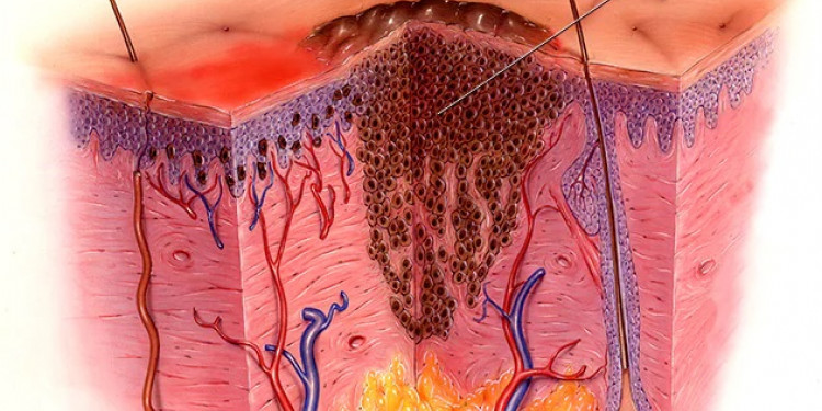 Avance argentino en tratamientos antitumorales: el caso de terapias anti-angiogénicas en pacientes con melanoma