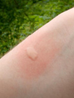 El mito de la sangre dulce: los mosquitos pican por el olor a pie