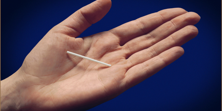 Un implante anticonceptivo