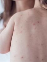 Alemania propone multar a los que no vacunen a sus hijos contra el sarampión