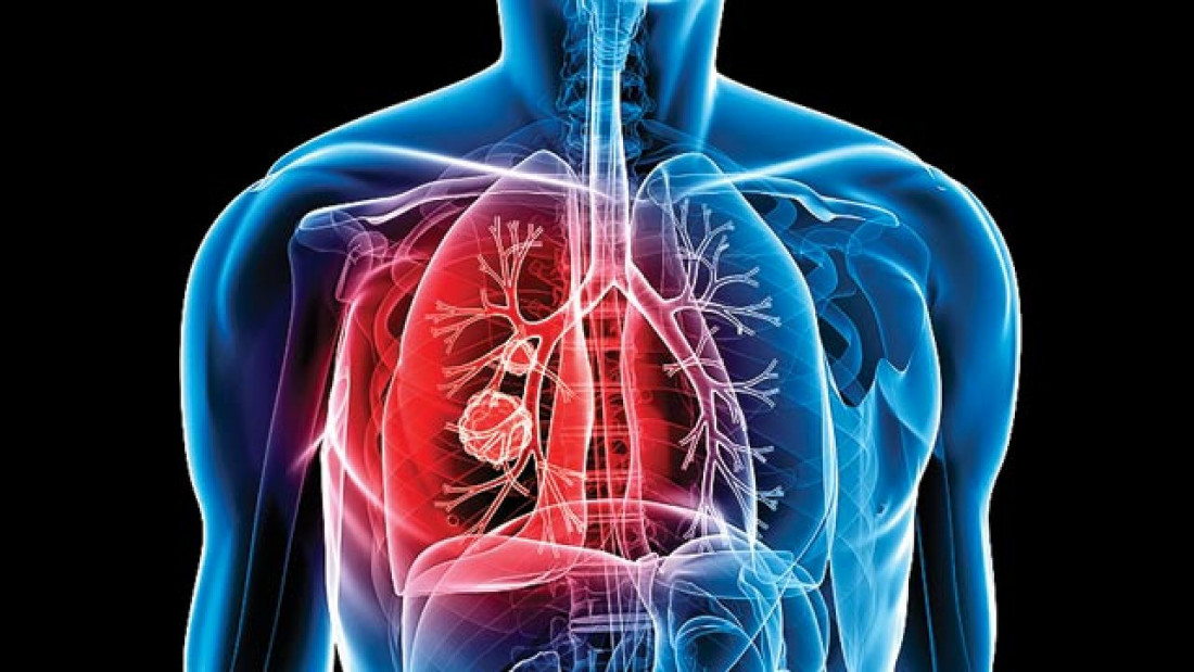 Casos de tuberculosis: Mendoza está por debajo de la media nacional