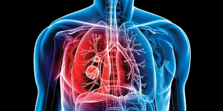 Casos de tuberculosis: Mendoza está por debajo de la media nacional